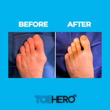 Load image into Gallery viewer, ToeHero™ Bunion Corrector